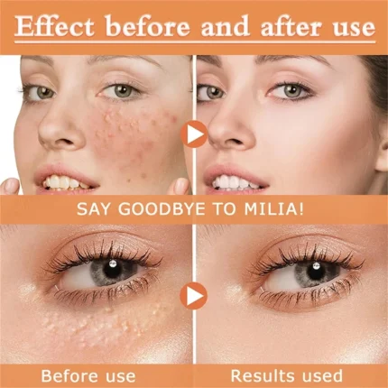 Eye Fat Particles Serum - Milia Treatment Anti-Puffiness Solution